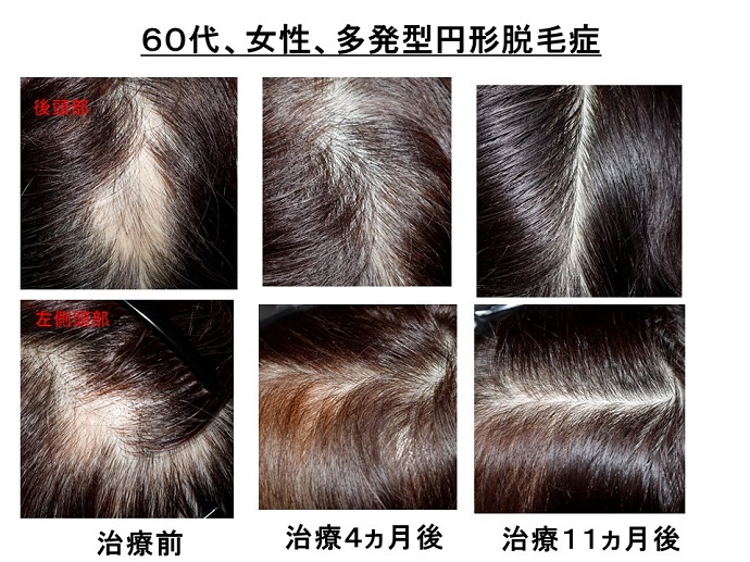 円形脱毛症　病院